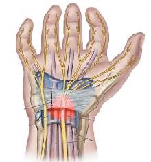 Nghiên cứu đặc điểm lâm sàng, điện cơ và đánh giá hiệu quả của tiêm đường hầm cổ tay trong điều trị hội chứng ống cổ tay