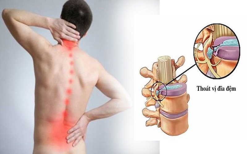 Đánh giá tác dụng điều trị đau lưng cấp do thoát vị đĩa đệm cột sống thắt lưng bằng điện châm theo quy trình 24 với Giáp tích L1- S1