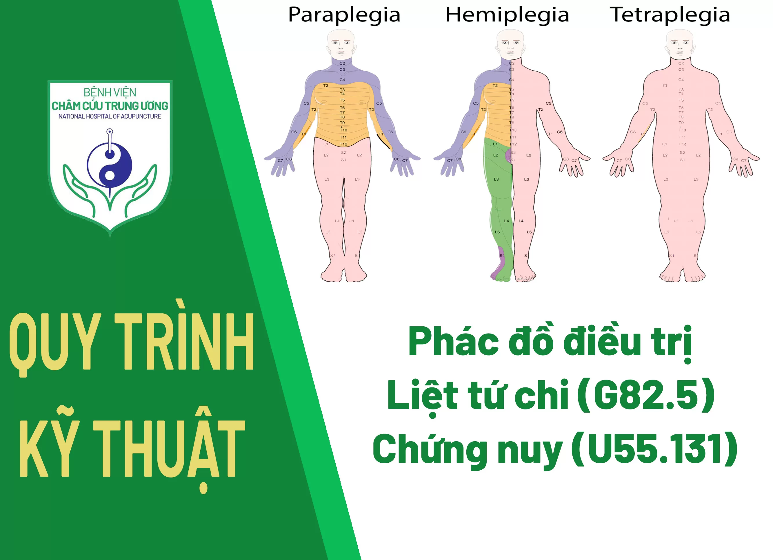 Phác đồ điều trị Liệt tứ chi (G82.5) - Chứng nuy (U55.131)