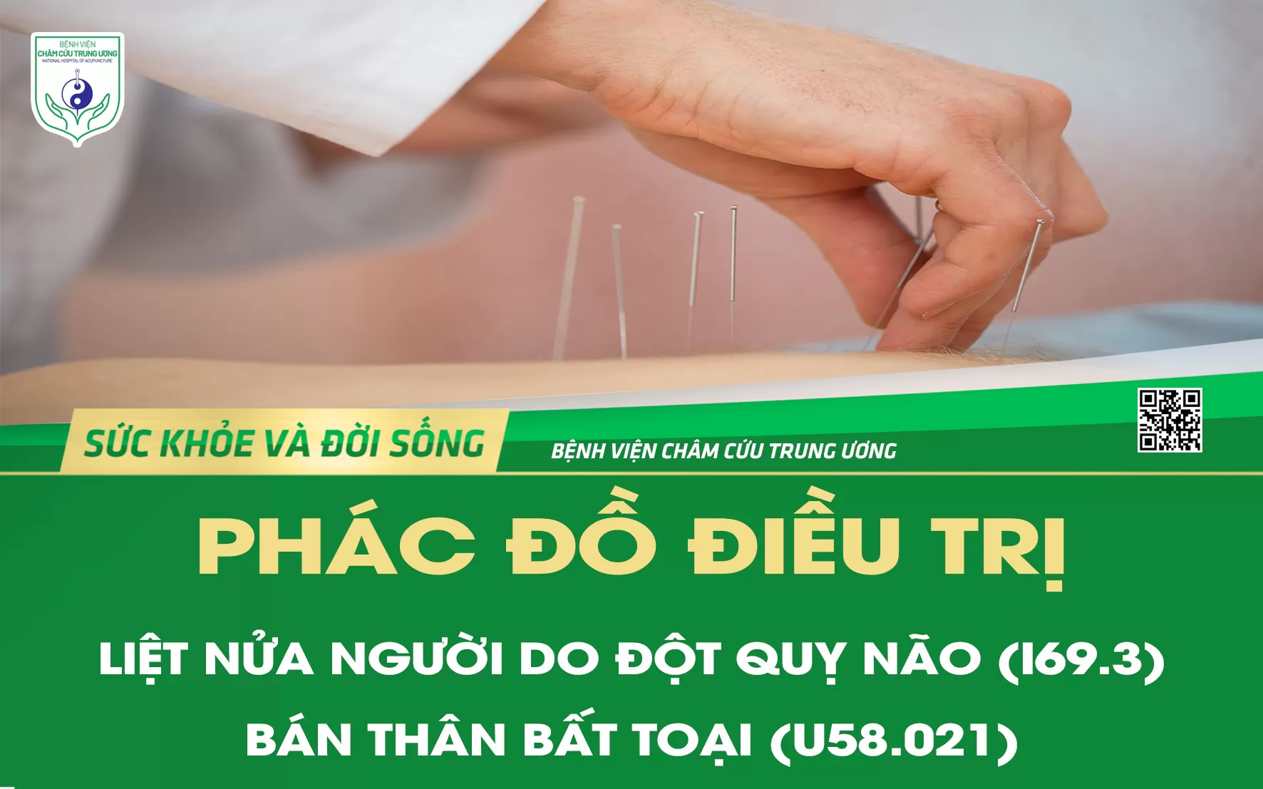 Phác đồ điều trị liệt nửa người do đột quỵ não (I69.3) - Bán thân bất toại (U58.021)