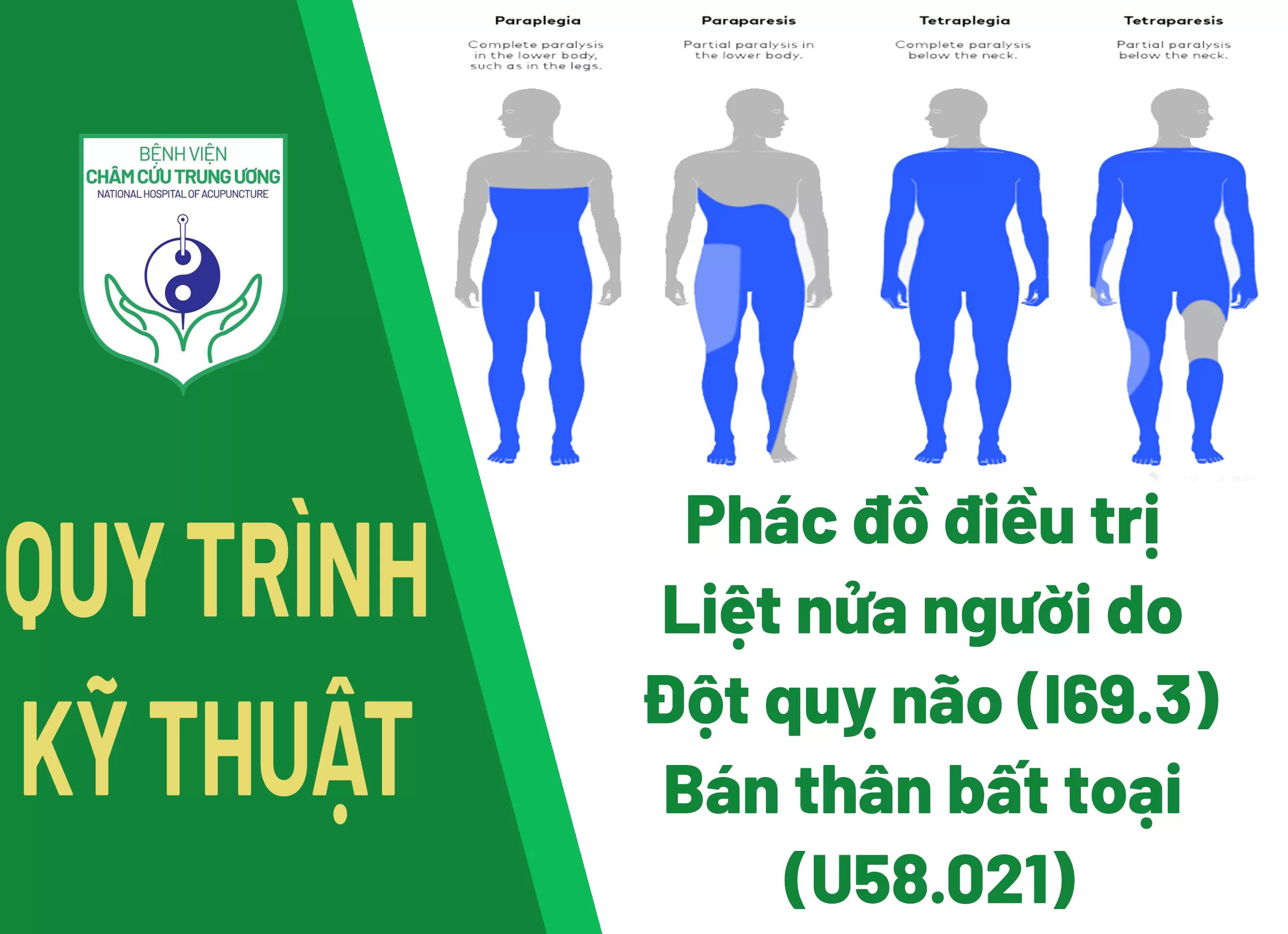 Phác đồ điều trị liệt nửa người do đột quỵ não (I69.3) - Bán thân bất toại (U58.021)