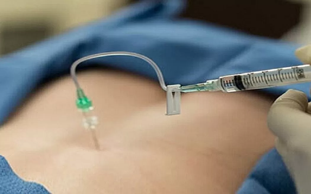 Thủy châm là gì? Các thông tin hữu ích về điện châm trong điều trị các chứng bệnh