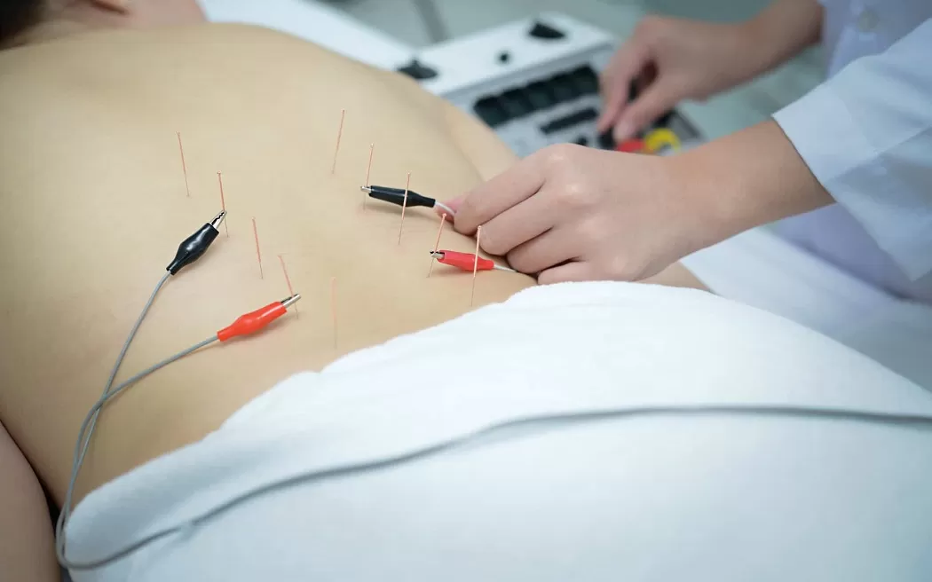 Điện châm là gì? Những điều bạn cần biết về phương pháp điện châm hiện nay