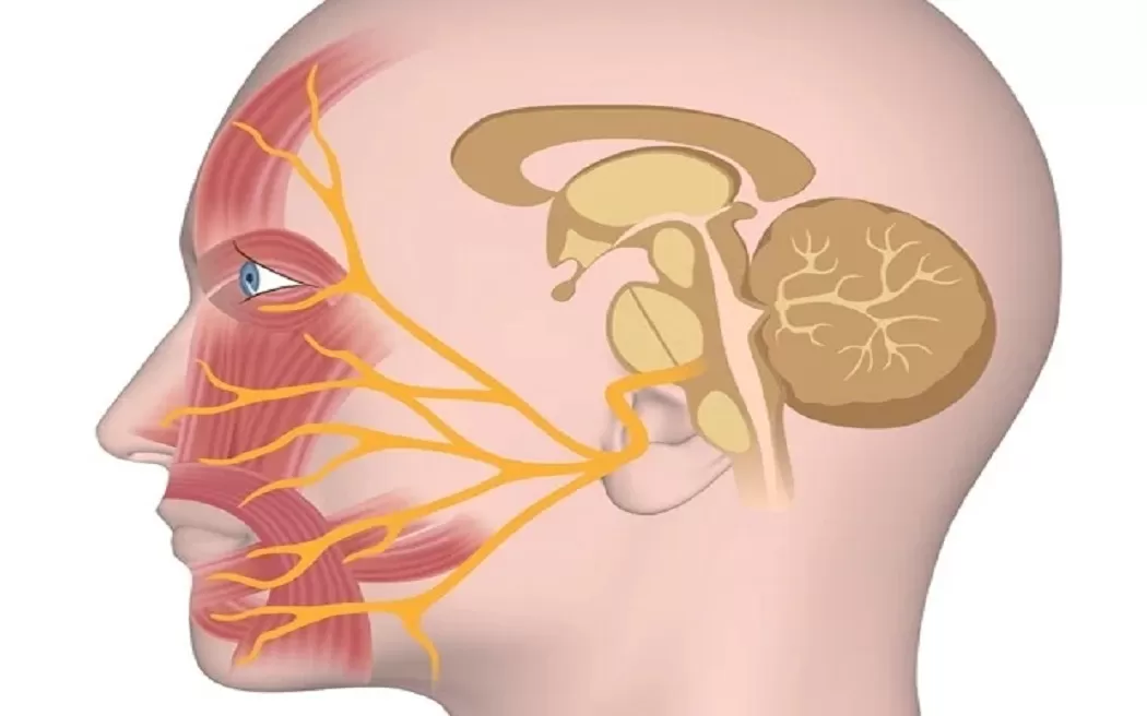 Liệt dây thần kinh số 7: Các dạng bệnh, nguyên nhân và phương pháp điều trị