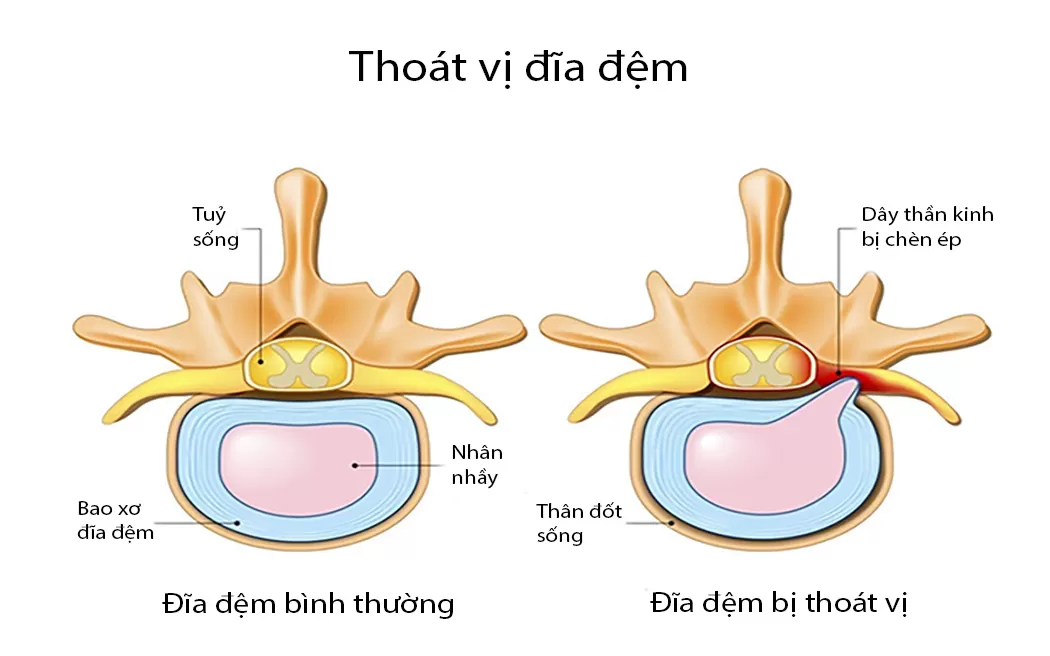 Điều trị thoát vị đĩa đệm bằng châm cứu: Kỳ vọng hiệu quả đến đâu?
