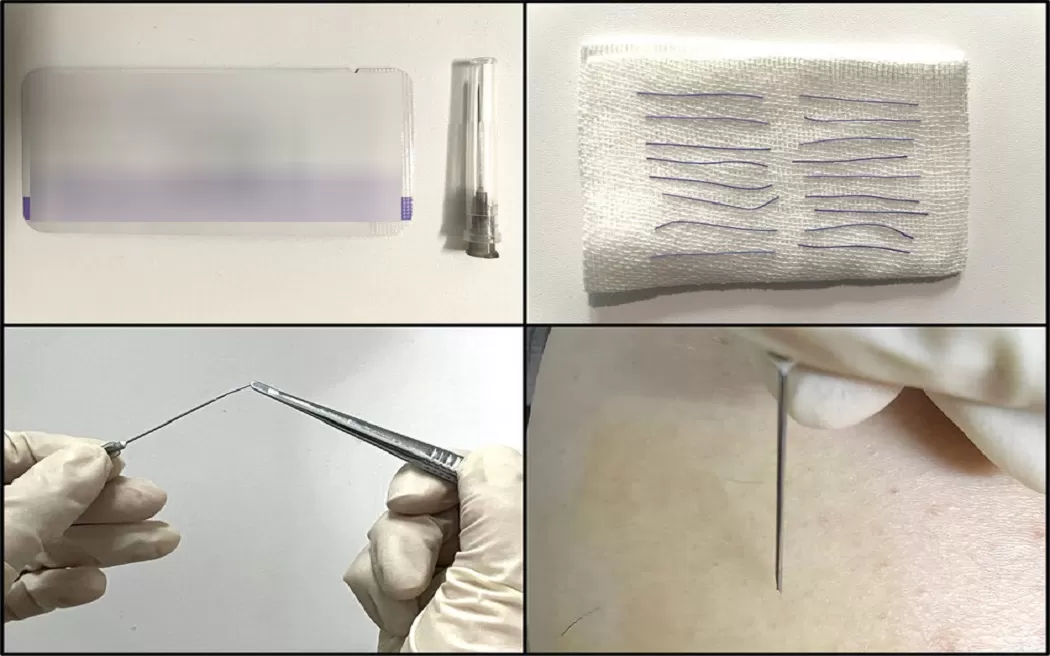 Liệu điều trị viêm xoang bằng châm cứu có khỏi dứt điểm không? Câu trả lời có tại đây