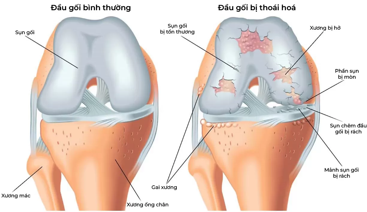 Thoái hóa khớp gối: Giải pháp tự nhiên tại Bệnh viện Châm cứu Trung ương