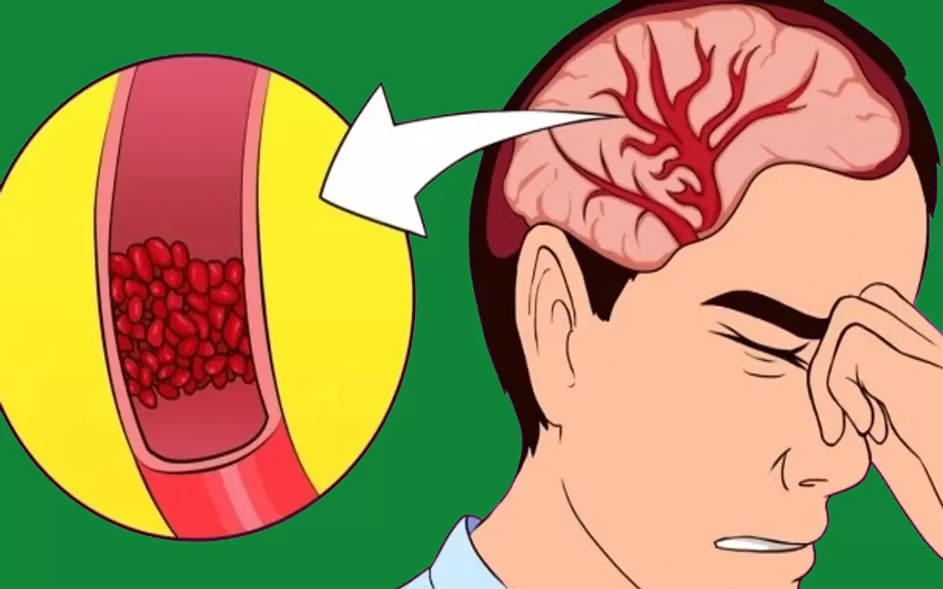 Điều trị đau đầu mất ngủ bằng châm cứu và phương pháp không dùng thuốc có hiệu quả? Câu trả lời có tại đây