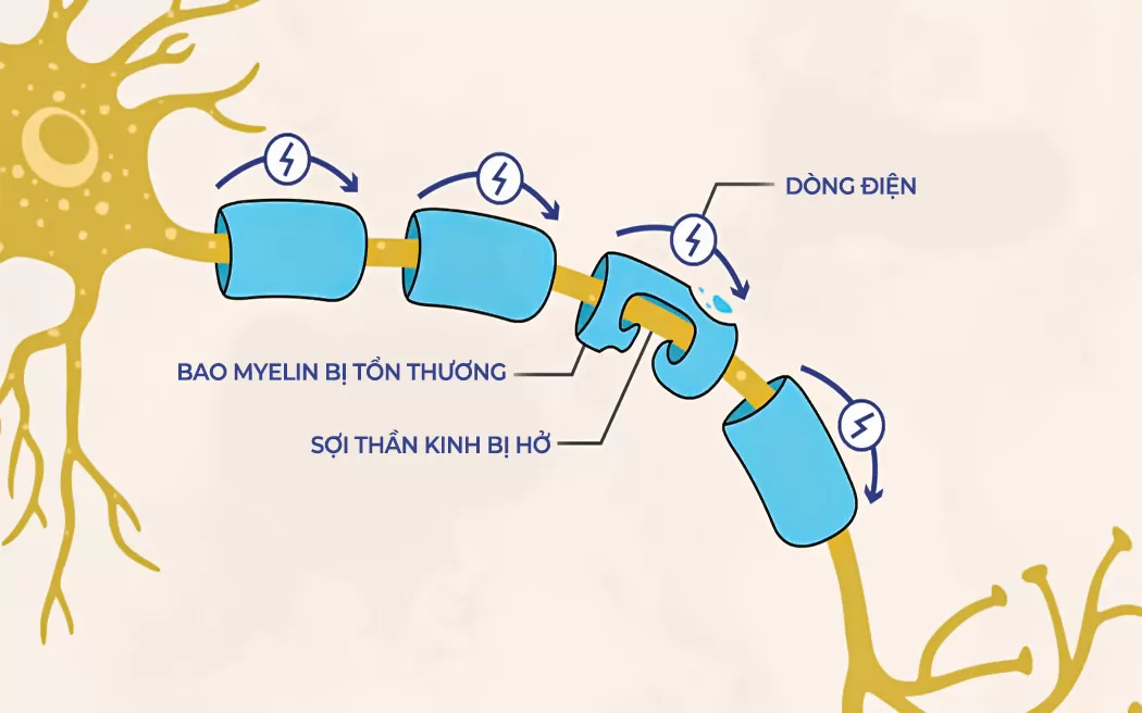 Dấu hiệu nhận biết viêm đa dây thần kinh (viêm đa rễ thần kinh) và giải đáp các thắc mắc về bệnh