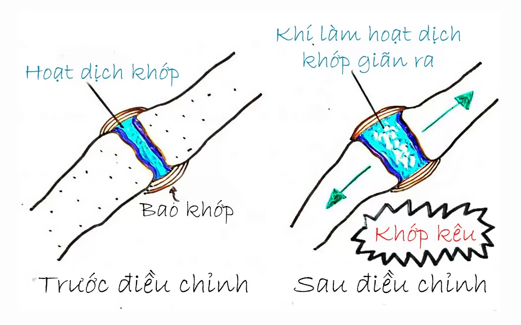 Tiếng khớp kêu lục cục có đáng lo? Hãy tìm hiểu nguyên nhân cụ thể tại đây