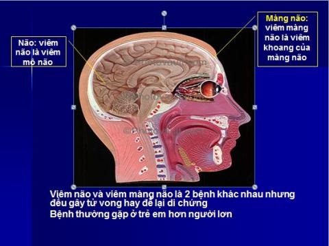 ĐÁNH GIÁ KẾT QUẢ ĐIỀU TRỊ SAU GIAI ĐOẠN CẤP Ở TRẺ VIÊM NÃO NHẬT BẢN BẰNG PHƯƠNG PHÁP ĐIỆN CH M  KẾT HỢP THỦY CH M, XOA BÓP BẤM HUYỆT   TẠI BỆNH VIỆN CH M CỨU TW