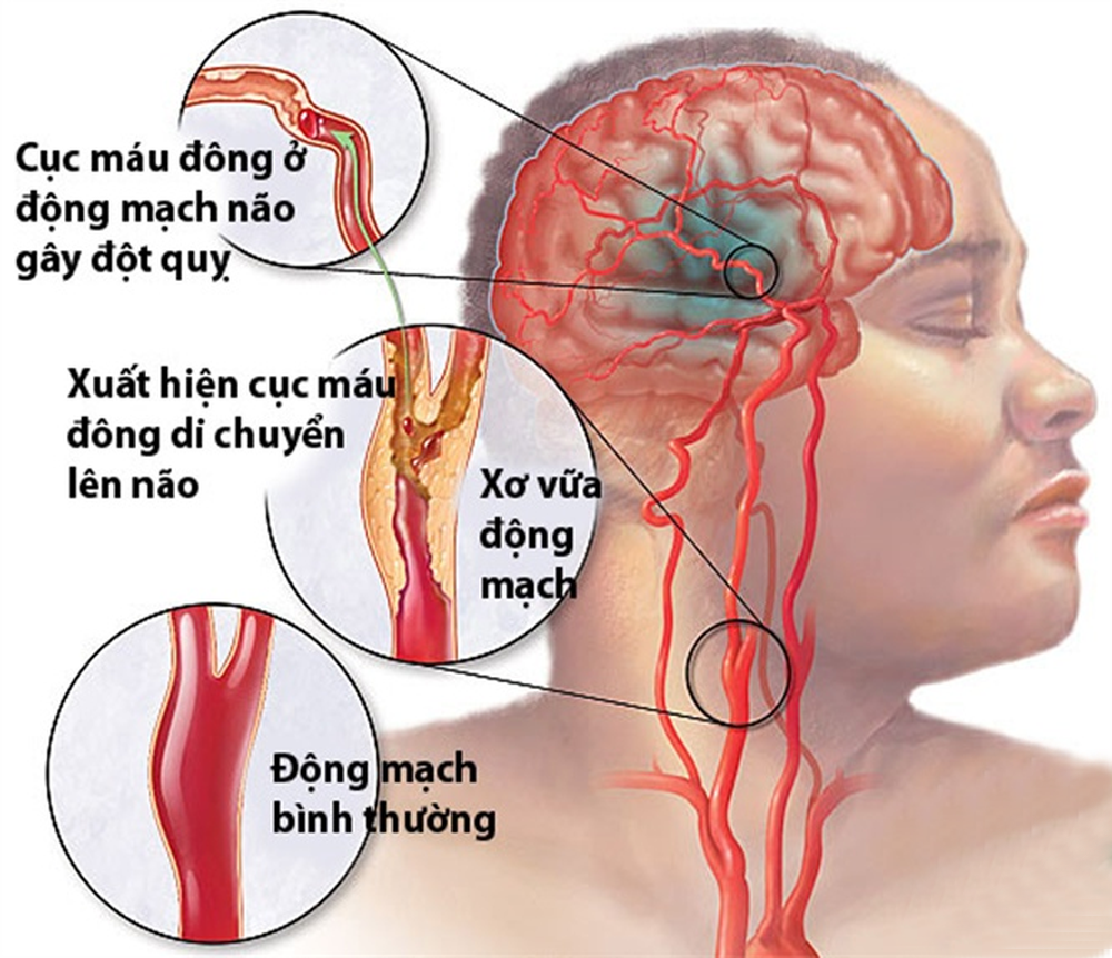 Đánh giá kết quả phục hồi chức năng vận động trên bệnh nhân liệt do TBMMN bằng xoa bóp bấm huyệt,tập vận động
