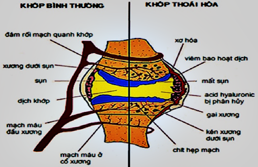 Nghiên cứu hiệu quả của điện châm kết hợp siêu âm điều trị thoái hóa khớp gối