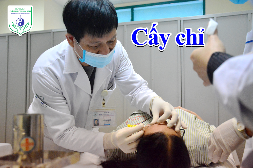 Cấy chỉ