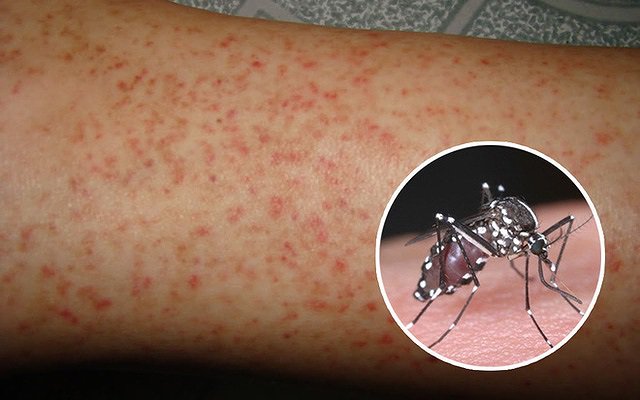 Đánh giá tác dụng của thủy châm vitamin nhóm B vào huyệt Túc tam lý trong hỗ trợ điều trị sốt xuất huyết Dengue không có sốc tại Bệnh viện Châm cứu