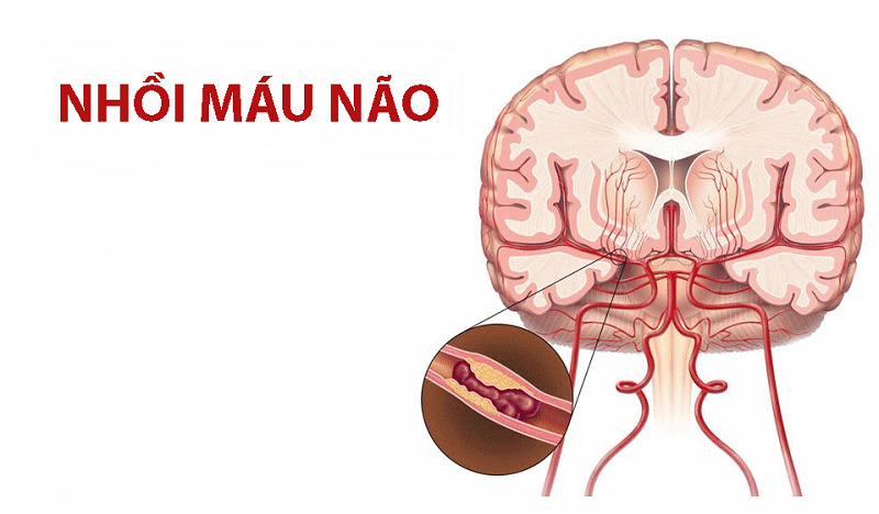 Đánh giá tác dụng của phúc châm kết hợp thể châm trong phục hồi chức năng vận động ở bệnh nhân liệt nửa người do nhồi máu não sau giai đoạn cấp
