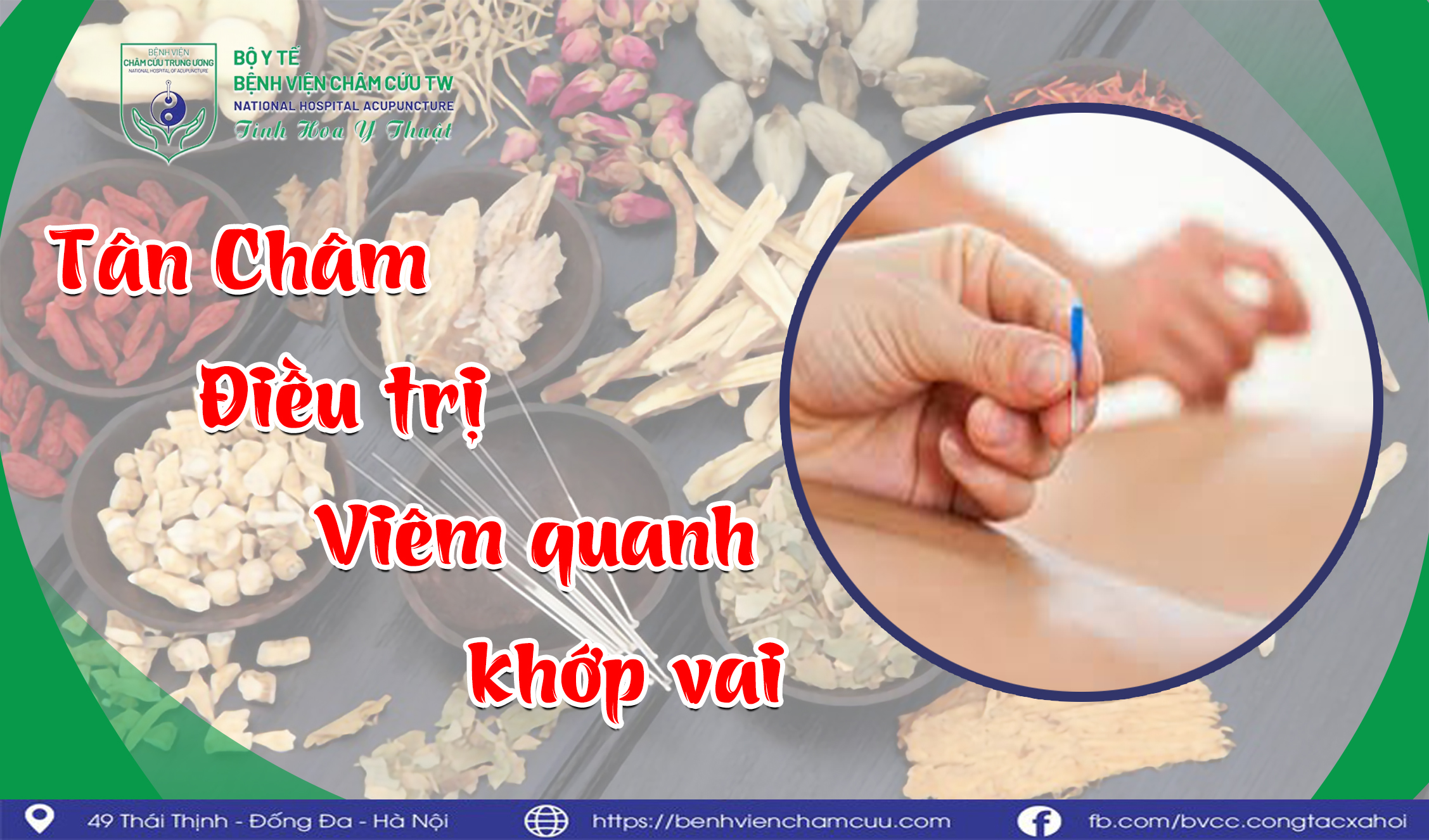 TÂN CHÂM ĐIỀU TRỊ VIÊM QUANH KHỚP VAI