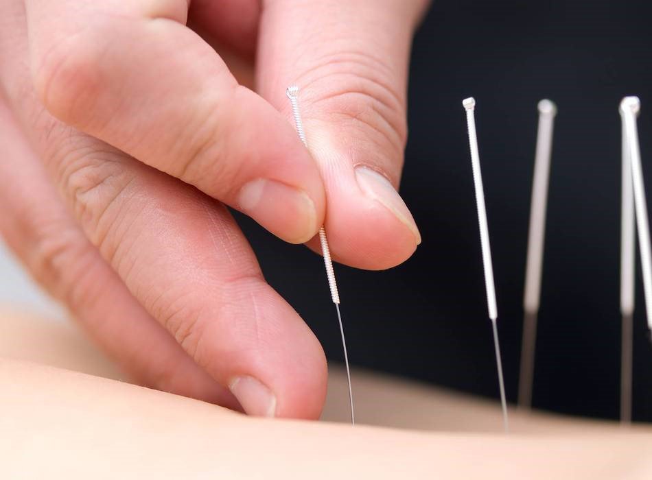 PHƯƠNG PHÁP PHỐI HUYỆT  ĐIỀU TRỊ CHỨNG ĐAU TRÊN LÂM SÀNG