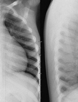 Chụp X-quang ngực thẳng