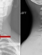 Chụp X-quang cột sống cổ thẳng nghiêng